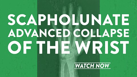 Scapholunate advanced collapse of the wrist