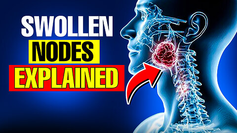 Swollen Lymph Nodes Causes Symptoms and Treatments