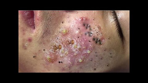 Blackhead extraction and pimplepoper, softpop