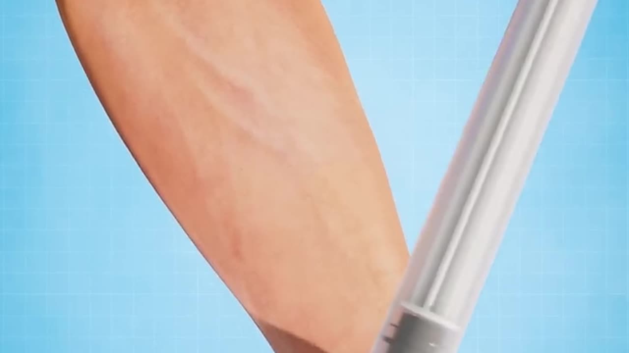 Explosion d'une veine