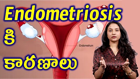 ఎండోమెట్రియోసిస్ కి కారణాలు ఏంటి? Risk Factors and Causes for Endometiosis Treatment | హోమియోపతి