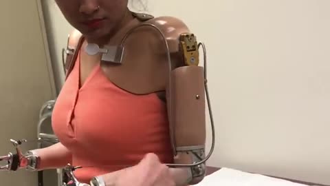 Prosthetic hands for a young woman