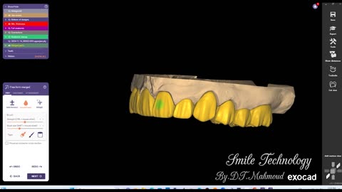 #design #naildesign #dental #dentaldesign #exocadexpert