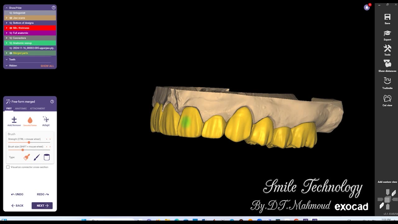 #design #naildesign #dental #dentaldesign #exocadexpert