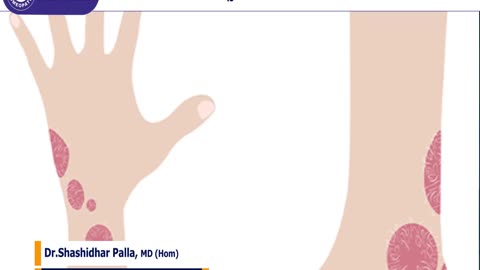 Psoriasis Homeopathy Treatments in Bangalore -Rich Care