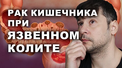 Обнаружена Связь ЯЗВЕННОГО КОЛИТА с РАКОМ Кишечника. Оказывается, не Всё Так Просто!