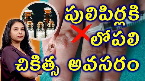 పులిపిర్లకి లేదా మొలలకి లోపలి చికిత్స అవసరం Advantages of Homeopathy Treatment for Warts | హోమియోపతి