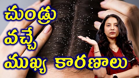 చుండ్రు వచ్చే ముఖ్య కారణాలు Causes and Riskfactors for Dandruff Treatment Cure Solution | హోమియోపతి