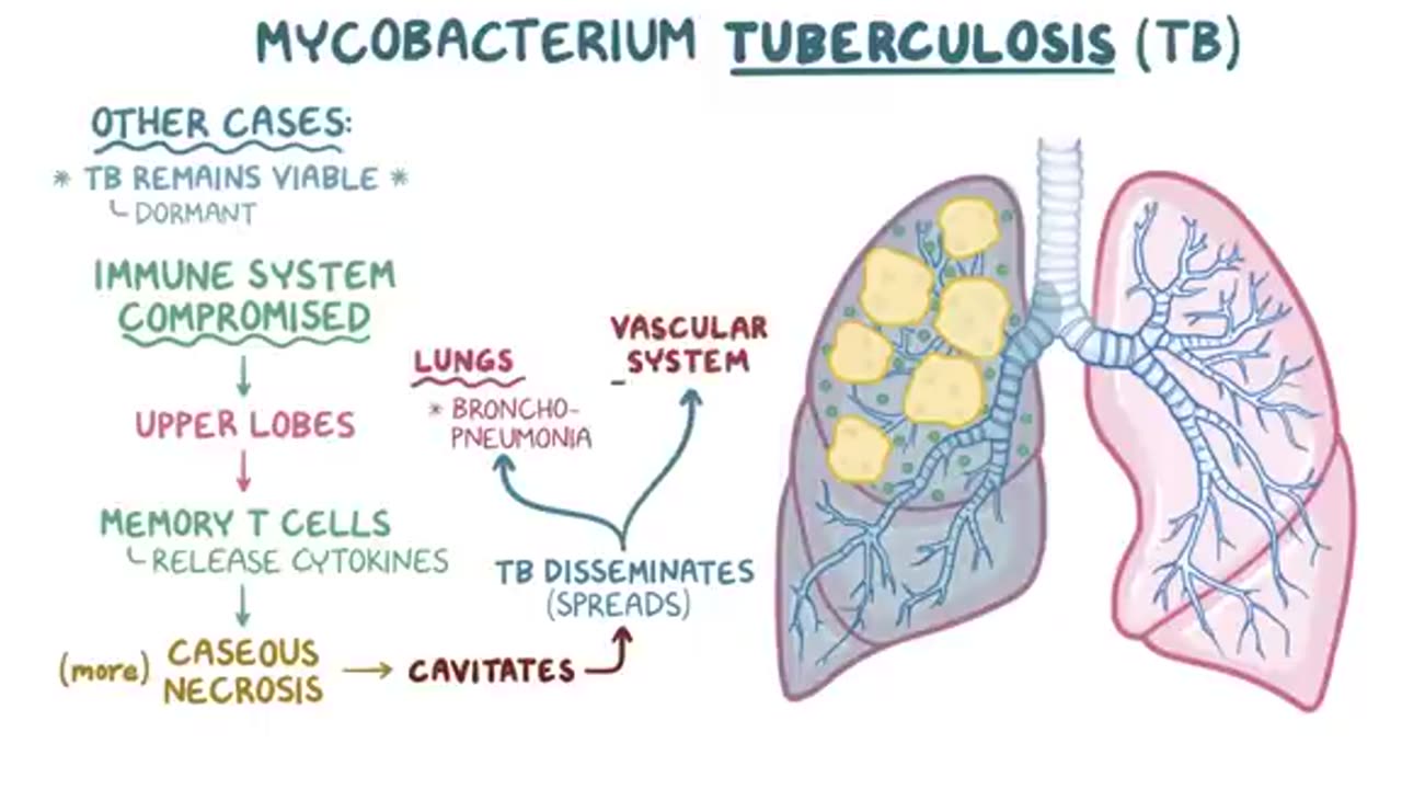 Tuberculosis - causes, symptoms, diagnosis, treatment, pathology