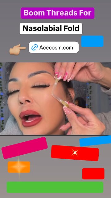 Nasolabial Folds Enhancement using Boom Threads 38mm