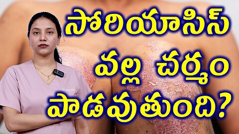 సోరియాసిస్ వల్ల చర్మం పాడవుతుంది Changes in the Body Due to Psoriasis Homeopathy Treatment Cure
