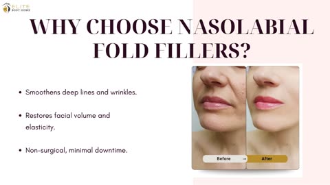 Nasolabial Fold Filler Dubai | Elite Body Home Polyclinic