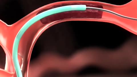 Brain Clot Removal Technique (Ischemic Strole)