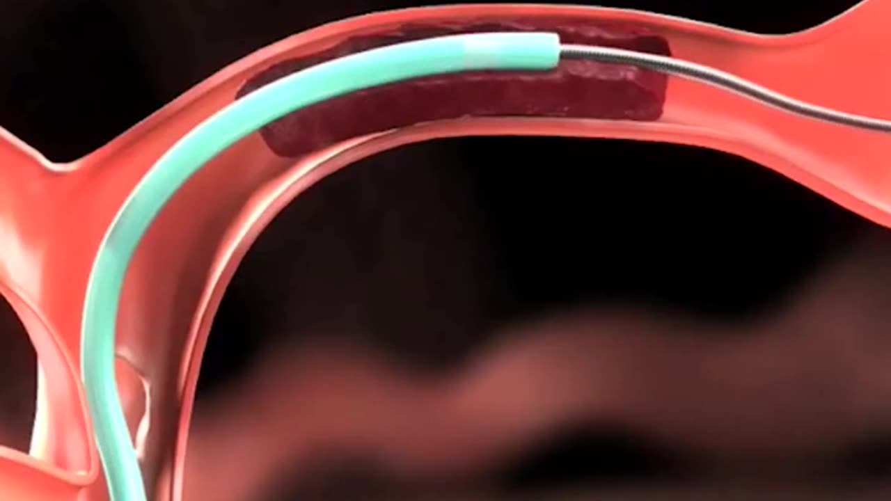 Brain Clot Removal Technique (Ischemic Strole)