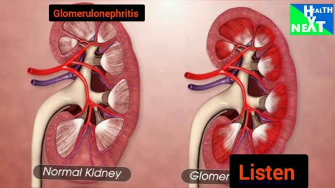 Glomerulonephritis infection can kill.