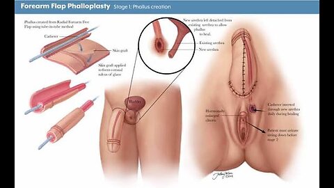 FEMALE TO MALE SURGERY HEXPLAINED *