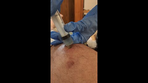 Draining Infected Knee (day 2, part 2) colloidal silver injection