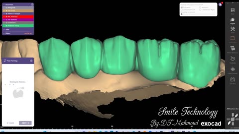 #design #naildesign #dental #dentaldesign #exocadexpert