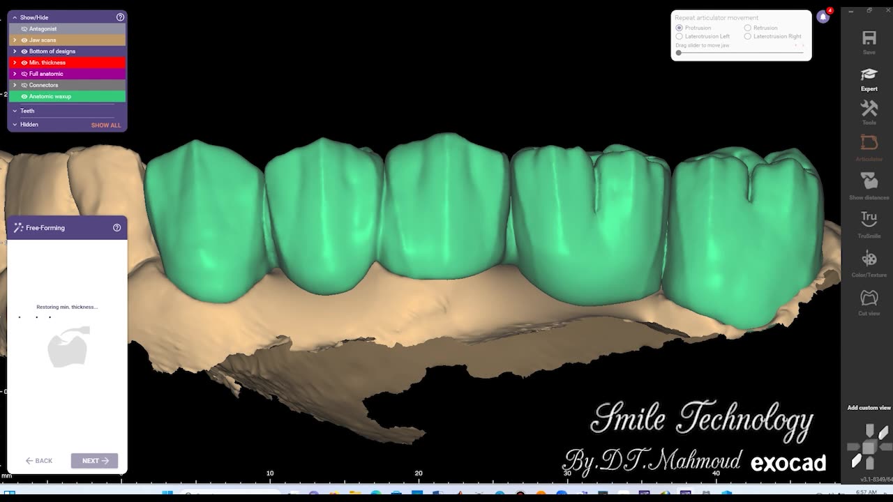 #design #naildesign #dental #dentaldesign #exocadexpert