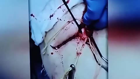 Skutki szczepienia covid 19