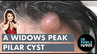 Splatter on the Wall Pilar Cysts