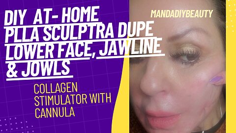 DIY PLLA Sculptra dupe w/ Cannula. Jowls & Jawline Collagen Biostimulator.