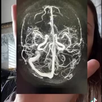 Horrific Brain Injury After Two Pfizer Vaccines 💉🧠