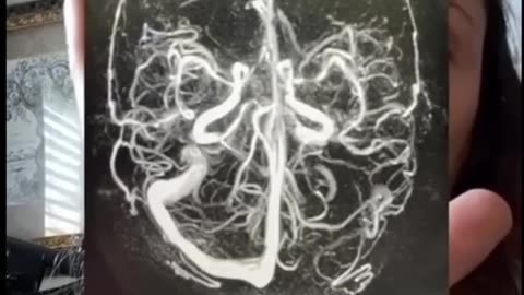 Horrific Brain Injury After Two Pfizer Vaccines 💉🧠