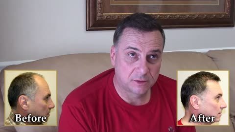 Dr. Brett Bolton | International Patient From Canada Achieves Amazing Hair Restoration Results