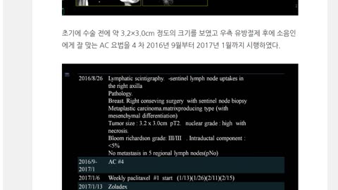 유방암의 표준 항암 AC 4차 이후 taxol을 12차 후 1년만에 전이된 소음인 유방암 환자