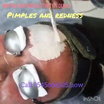 Best treatments for pimples/acne, face scars and redness