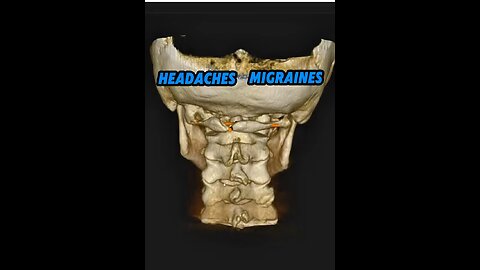 Does whiplash cause headaches? | Neckwise upper cervical chiropractic