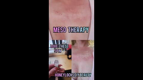 Doing alittle Meso Therapy absolutely love these 5 pin 💉 💖
