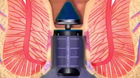 Stapled Haemorrhoidectomy using the PPH System (3D Animation)