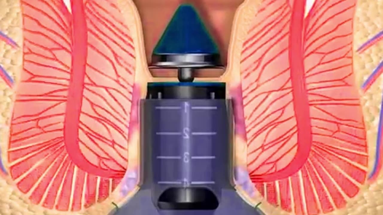 Stapled Haemorrhoidectomy using the PPH System (3D Animation)