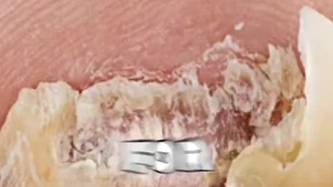 Say Goodbye to Nail Fungus Forever!