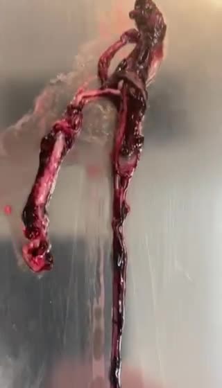 Funeral director, John O'Looney displaying massive blood clots from 30 year old