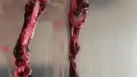 Funeral director, John O'Looney displaying massive blood clots from 30 year old