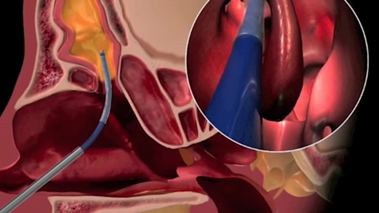 Balloon Sinuplasty Procedure 3D Animation