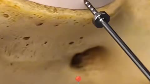 How Doctors Replace a Damaged Spinal Disc with an Artificial One