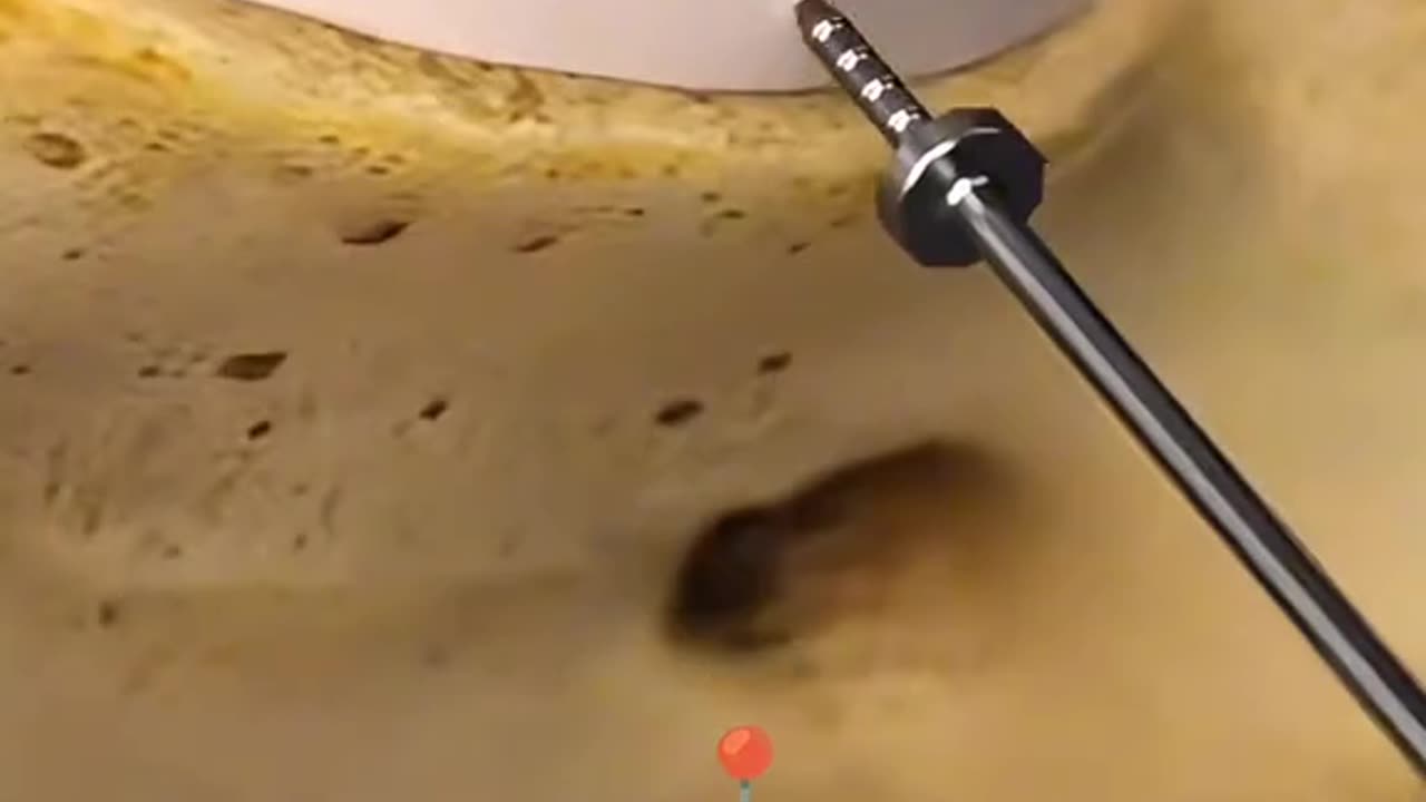 How Doctors Replace a Damaged Spinal Disc with an Artificial One