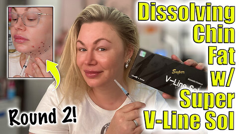 Dissolving Chin Fat w/ Super V-Line Sol: Round 2 | AceCosm.com and code Jessica10 saves