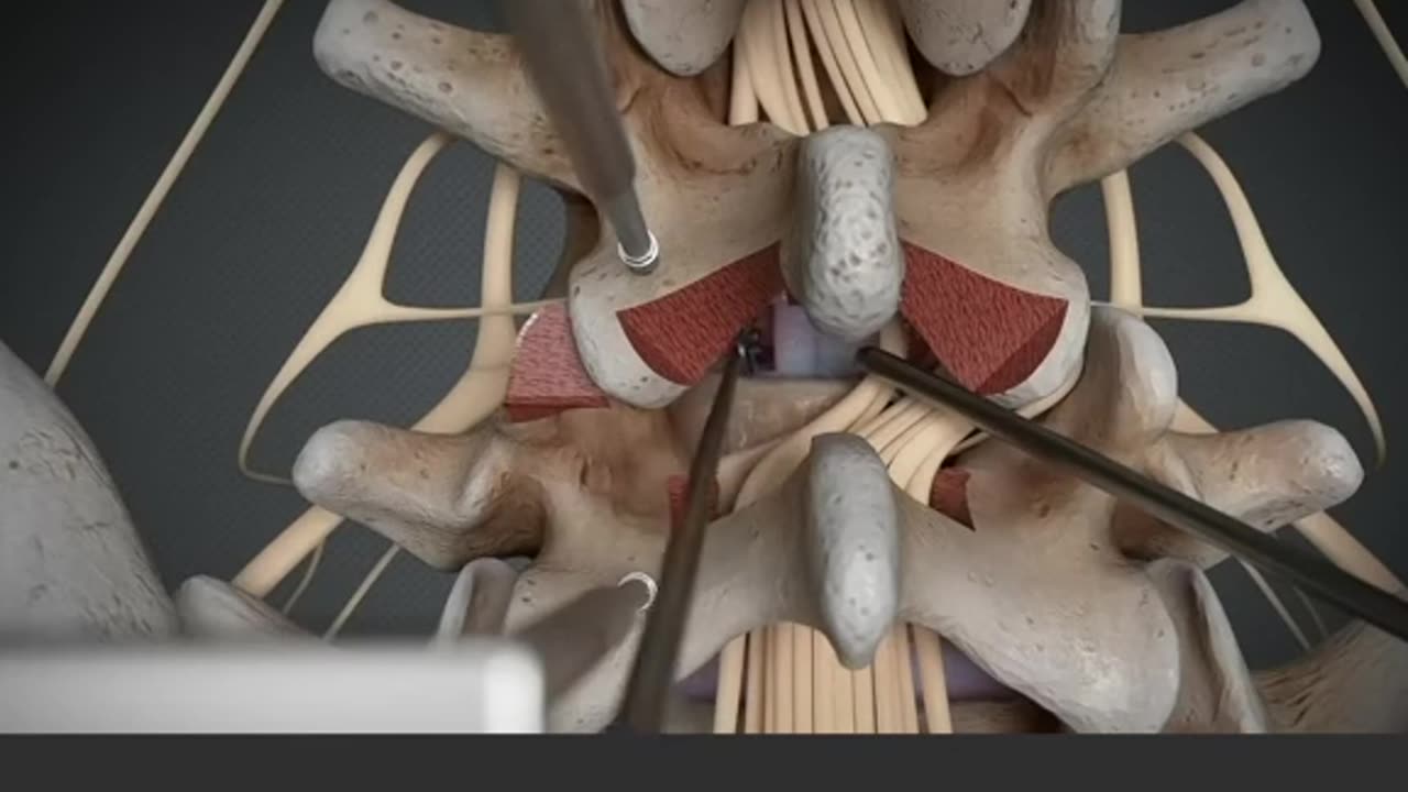 Removing Herniated Disc Surgery 3D Animation