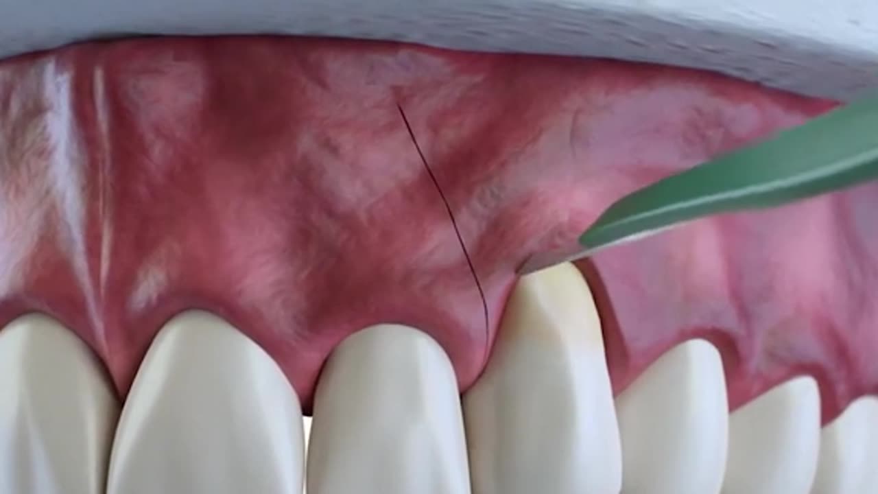 Subepithelial Connective Tissue Grafting Procedure 3D Animation