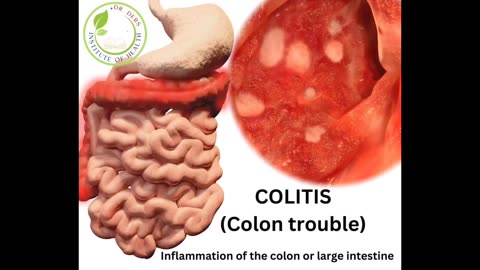 COLITIS (colon trouble) & CONSTIPATION causes and natural remedies with Dr. Debra E. S. Williams, ND