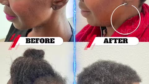 Woman Afro hair transplant (Lowering hairline