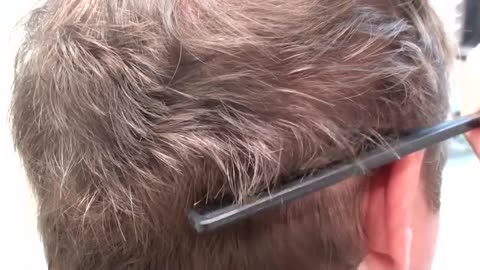 Natural Hair Transplant Scar Correction | Dr. Brett Bolton