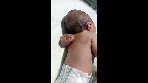 👶 MMC (Myelomeningocele) Newborn | Pre-Operative NICU Care | Waiting for Neurosurgeon