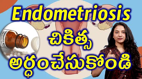 ఎండోమెట్రియోసిస్ చికిత్స అర్ధంచేసుకోండి Advantages of Homeoapathy in Treating Endometriosisహోమియోపతి
