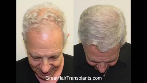 Dr. Brett Bolton Performs Amazing Corrective Hair Transplant